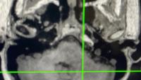 focused ultrasound brain scan